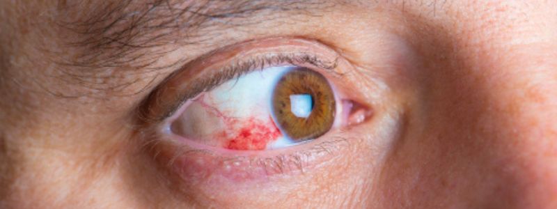 How Diabetes Affects the Eyes