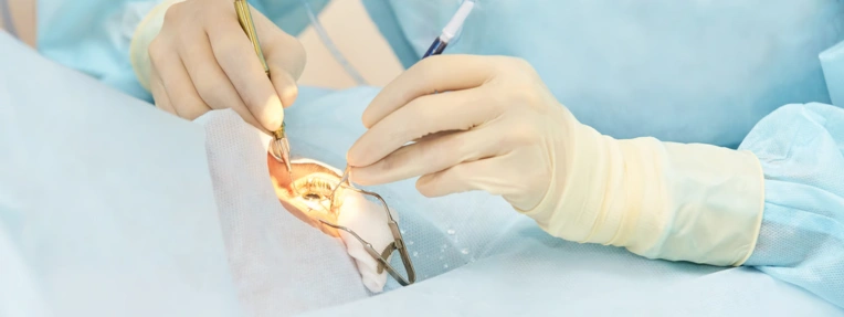 cataract surgery