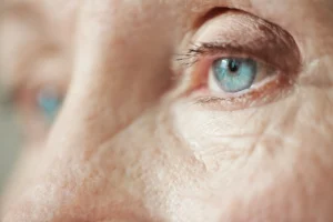 Immature Cataract