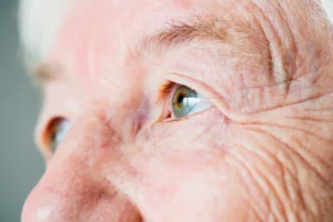 Mature Cataract